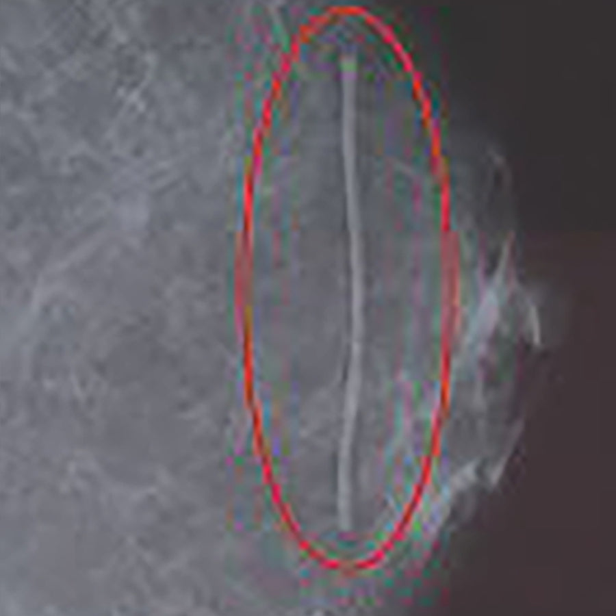 Features<li>A valuable marking tool to reduce confusion from complex scar tissue.</li><li>Our radiolucent skin markers will not burnout.</li><li>Offers dual density views.</li><li>Unique flexible marker ensures precise and easy placement.</li>