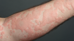 contrast allergy management